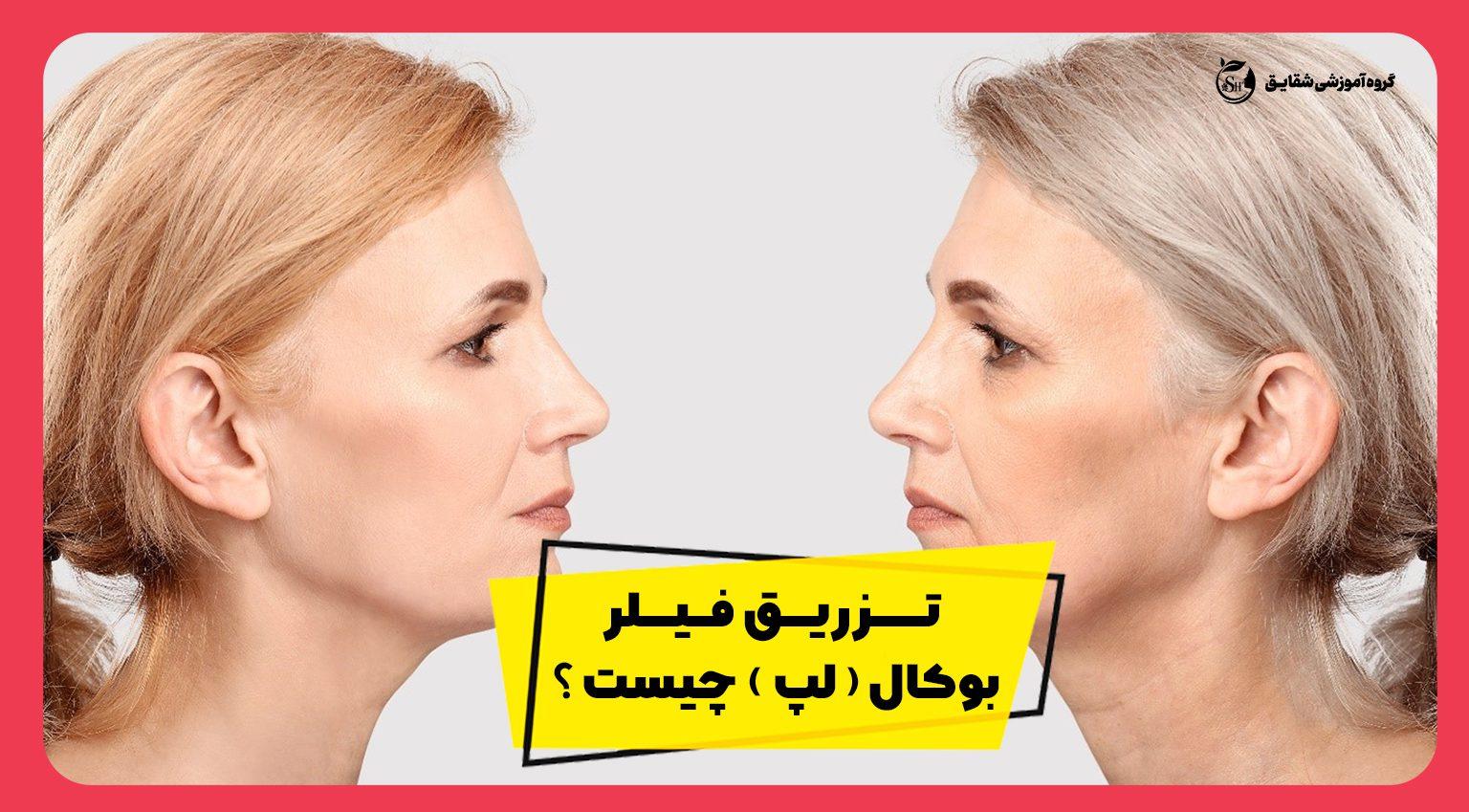 4 مورد تزریق فیلر بوکال!! تزریق فیلر بوکال ( لپ ) چیست ؟